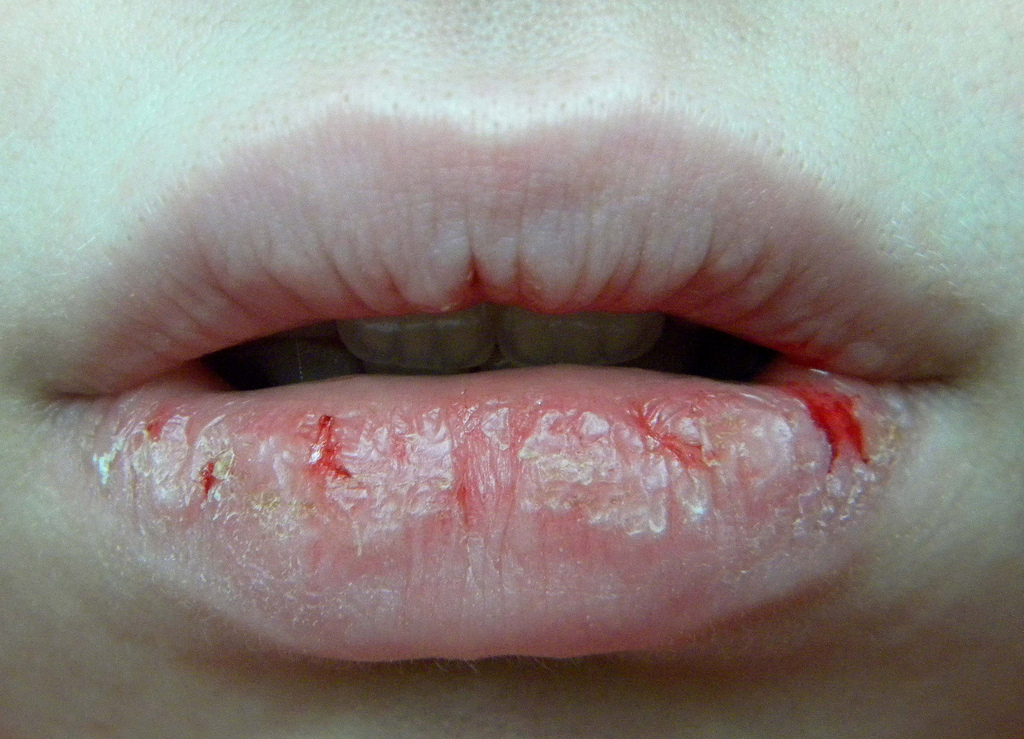 Image result for artikel merawat bibir kering